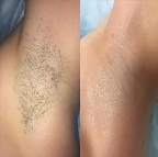 картинка услуги Подмышки