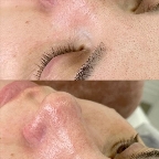 картинка услуги голливудская чистка лица