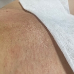 картинка услуги Комплекс 1 Подмышечные впадины, гл.бикини