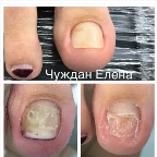 картинка услуги ПРОТЕЗИРОВАНИЕ (до формирование ногтевой пластины )