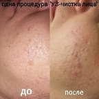 картинка услуги УЗ чистка бикини(лобок)