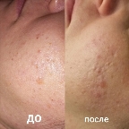 картинка услуги УЗ чистка лица