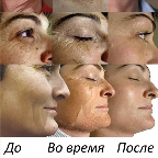 картинка услуги Ретиноевый желтый пилинг