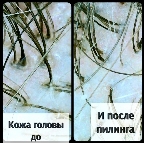 картинка услуги Процедура против перхоти/ жирной кожи головы/ выпадения