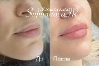 картинка услуги Увеличение губ